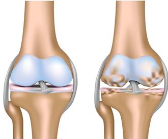 arthrosis osteoarthritis